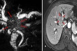 Cholangiocarcinoma