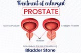 Prostate health: Tips for prevention and early detection of prostate cancer