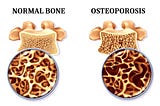 What is Osteoporosis or Osteopenia and what do you need to know?