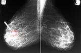 Are You at Risk for Breast Cancer?