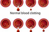 Hemophilia: