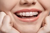 The Advantages of Clear Braces for Adults in Boca Raton
