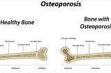 Bone Pathologies: Common Diseases and Conditions Affecting Bones