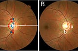 AI determines sex from fundoscopy images: what is it looking at?