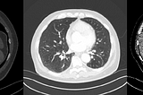 Decoding CT Scans: Simplifying Window Settings