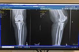 How Knee Replacement Reminded Me that We All Get Older, But Being Old is a Choice