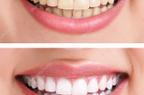 A Million Dollar Smile
5 Tips for Healthy Teeth