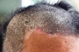How to treat Tinea Capitis “Itchy Scalp”?