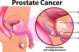 Navigating Prostate Health: Understanding BPH, Prostatitis, and Prostate Cancer - Dr.