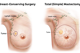 Using KL divergence and Mutual Information as a hybrid feature selection method in breast cancer…