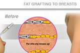 Natural Alternatives: Breast Fat Grafting