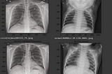 Detecting COVID-19 induced Pneumonia from Chest X-rays with Transfer Learning: An implementation…