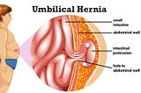 Umbilical Hernia Treatment In Indore, Umbilical Hernia Surgery In Indore | Dr. Achal Agrawal