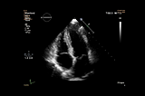 Finding Diagnosis in a Sea of Transcripts: The Case of a Hypertrophic Cardiomyopathy Patient