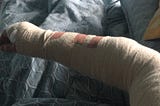 Author’s right arm in a cast, going above the elbow