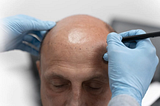 Scalp Micropigmentation in Mumbai: Clinic Selection Guide By Victress