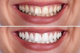 About Professional Whitening…