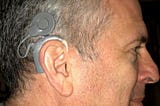 THE PARADOX OF TEMPORARY PERMANENCE: MY COCHLEAR IMPLANT JOURNEY