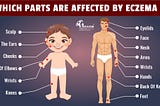 Atopic dermatitis treatment in homeopathy