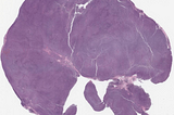 Mantle Cell Lymphoma, Negative for Cyclin-D1 Stain