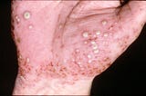 Pustular Psoriasis