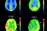 Measuring oxygen use in the brain: the how and why of a new MRI technique.