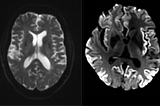 What Prion Diseases (99% Fatal) Have To Do With Covid-19 Or Its Vaccines.