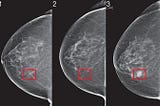 Revolutionary AI System From MIT Predicts Breast Cancer Five Years in Advance