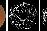 Retina Blood Vessel Segmentation using VGG16-UNET