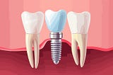 How to Choose the Right Dental Implant Specialist