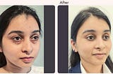 Does Blepharoplasty Remove Dark Circles?