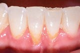 How To Reverse Gingivitis And Receding Gums?
