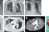 Lung transplantation in corona patients