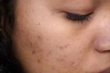 The Secret to Treating Acne Scars Revealed