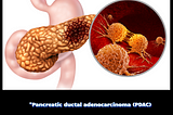 Rising Cases of Pancreatic Cancer and what boosting NK cell activity can do?