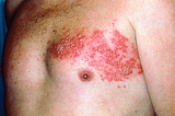 A severe case of shingles across the lift side of the upper chest running in a belt like patteern.