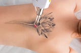 Tattoo Removal in Delhi Advanced Laser Technology Magical Results