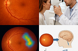 Retinal Revelations: Harnessing Deep Learning to Unmask Silent Brain Infarction and Predict Stroke…