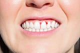 Bleeding Gums: Exploring Causes and Seeking Effective Solutions