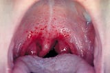 Understanding Strep Throat: Symptoms, Treatment, and Prevention