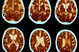 Why Drugs for Alzheimer’s Are So Hard to Develop