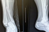 An X-ray showing a broken fibula and a dislocated ankle.