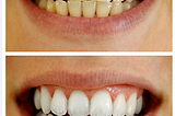 Teeth whitening