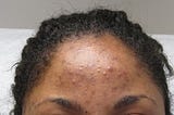 Chemical peels nyc — acne and hyperpigmentation before a Vi Peel