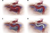 Endovascular Management Of Carotid-Cavernous Fistula (CCF)