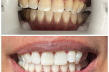 A before and after comparison of a person’s teeth