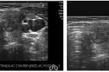 The Basic Classification of Thyroid Tumors on UltraSound Images using Deep Learning Methods
