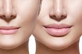 Lip Fillers Harley Street as Anti-Ageing Solutions