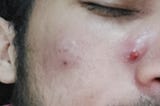 Cystic acne, its repercussions and Accutane