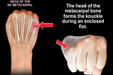 “The Word on the Street about Boxer Fractures: Insights from Over 1000 YouTube Single Video…